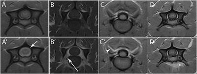 Magnetic resonance imaging highlights the meningeal involvement in steroid responsive meningitis-arteritis and suggests the inflammation of the surrounding tissues (70 cases)